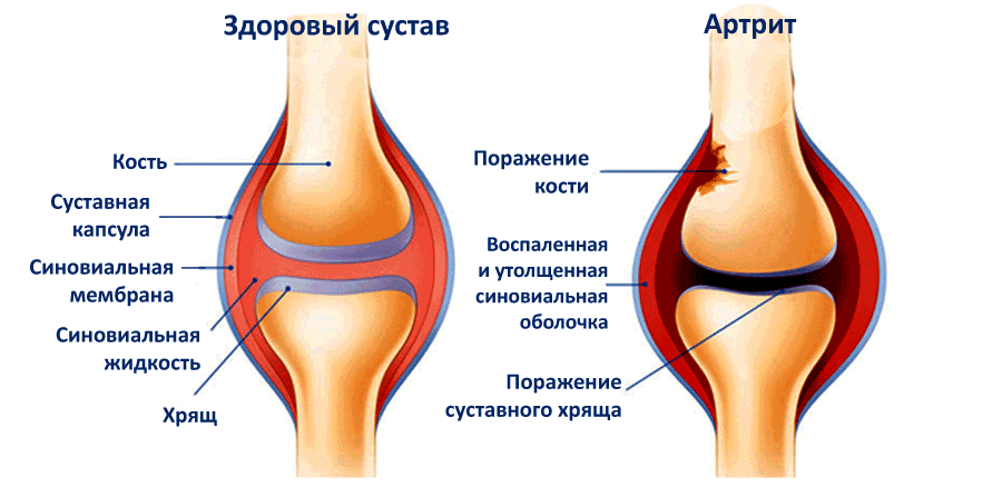 Сравнение здорового сустава и сустава с артрозом